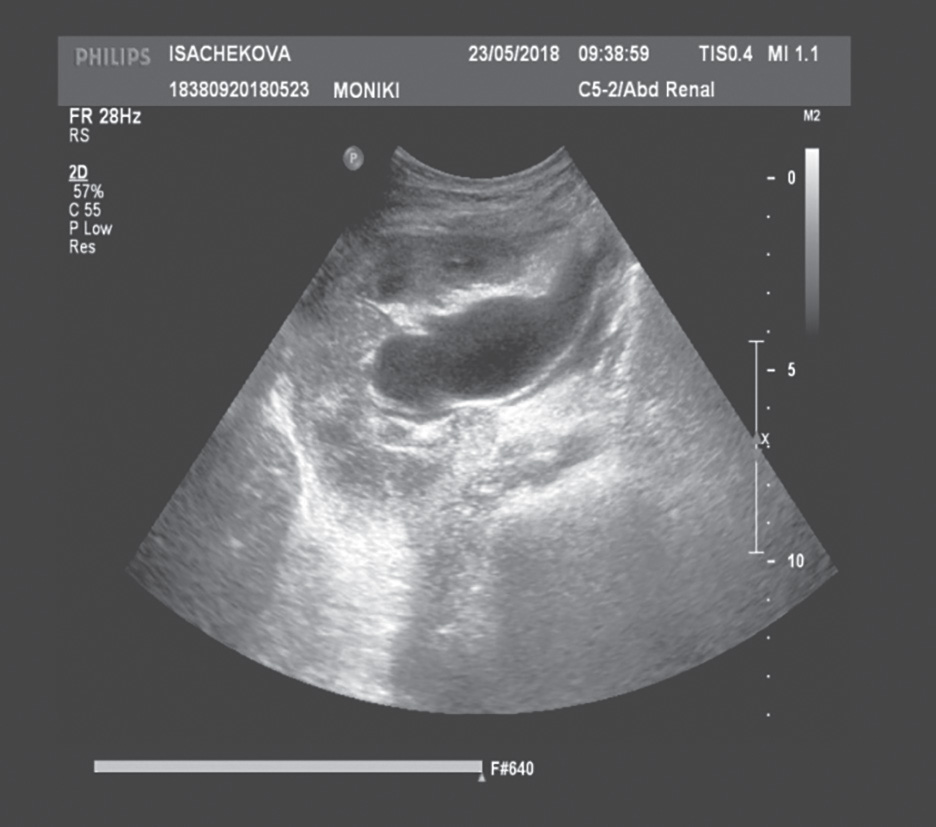 Рис. 8-1. УЗИ-картина уретерогидронефроза пациентки на 38-й неделе беременности