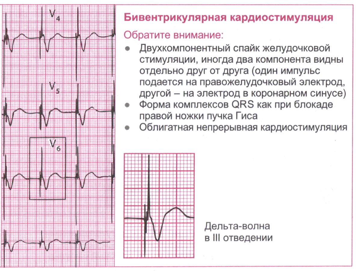 Бивентрикулярная кардиостимуляция