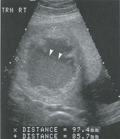 Некроз миоматозного узла при беременности. На поперечном снимке (TRN) правой части (RT)