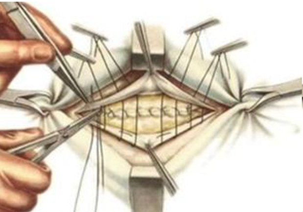 Рис. 186. Подшивание нижнего лоскута апоневроза к верхнему апоневроза П-образными швами (2-этап)