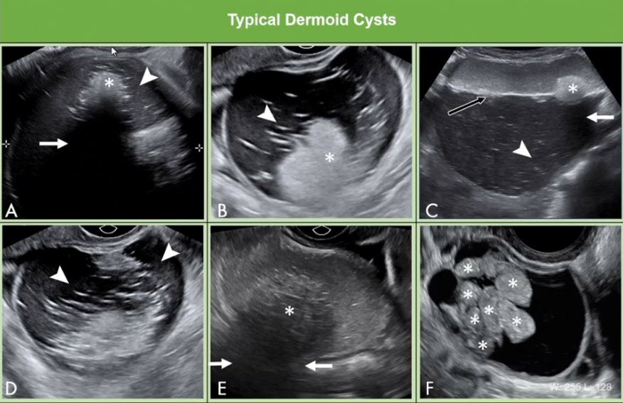 Typical Dermoid Cysts