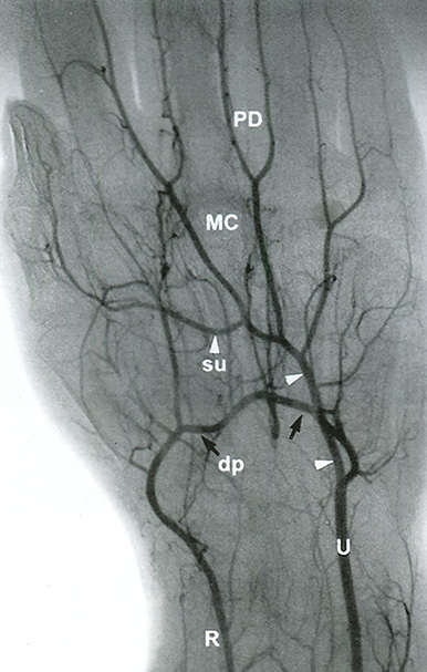 Рис. 14.5. Лучевая артерия (R) заканчивается глубокой ладонной дугой (dp - черные стрелки)