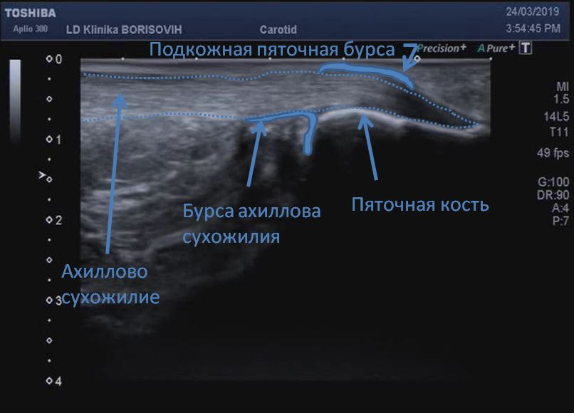 Анатомические структуры заднего скана – ахиллово сухожилие и проекции бурс задней области