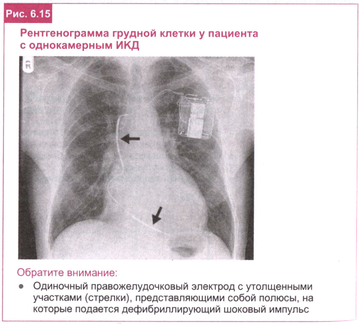 Рентгенограмма грудной клетки у пациента с однокамерным ИКД