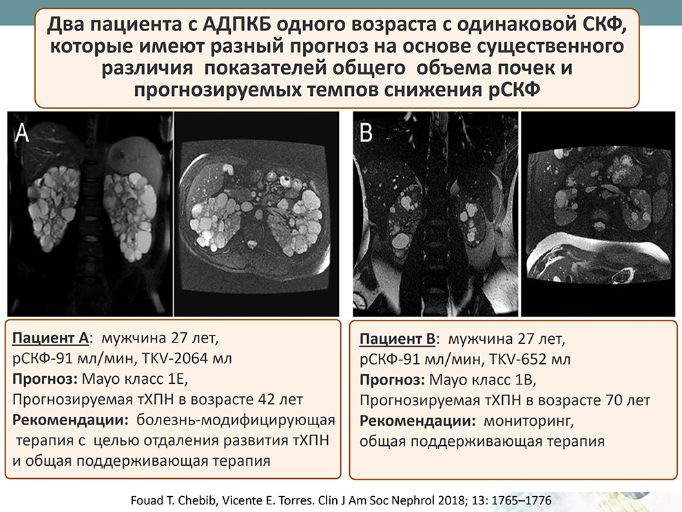 Два пациента с АДПКБ одного возраста с одинаковой СКФ, которые имеют разный прогноз