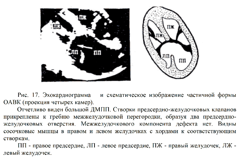 Рис. 17. Эхокардиограмма и схематическое изображение частичной формы ОАВК (проекция четырех камер).