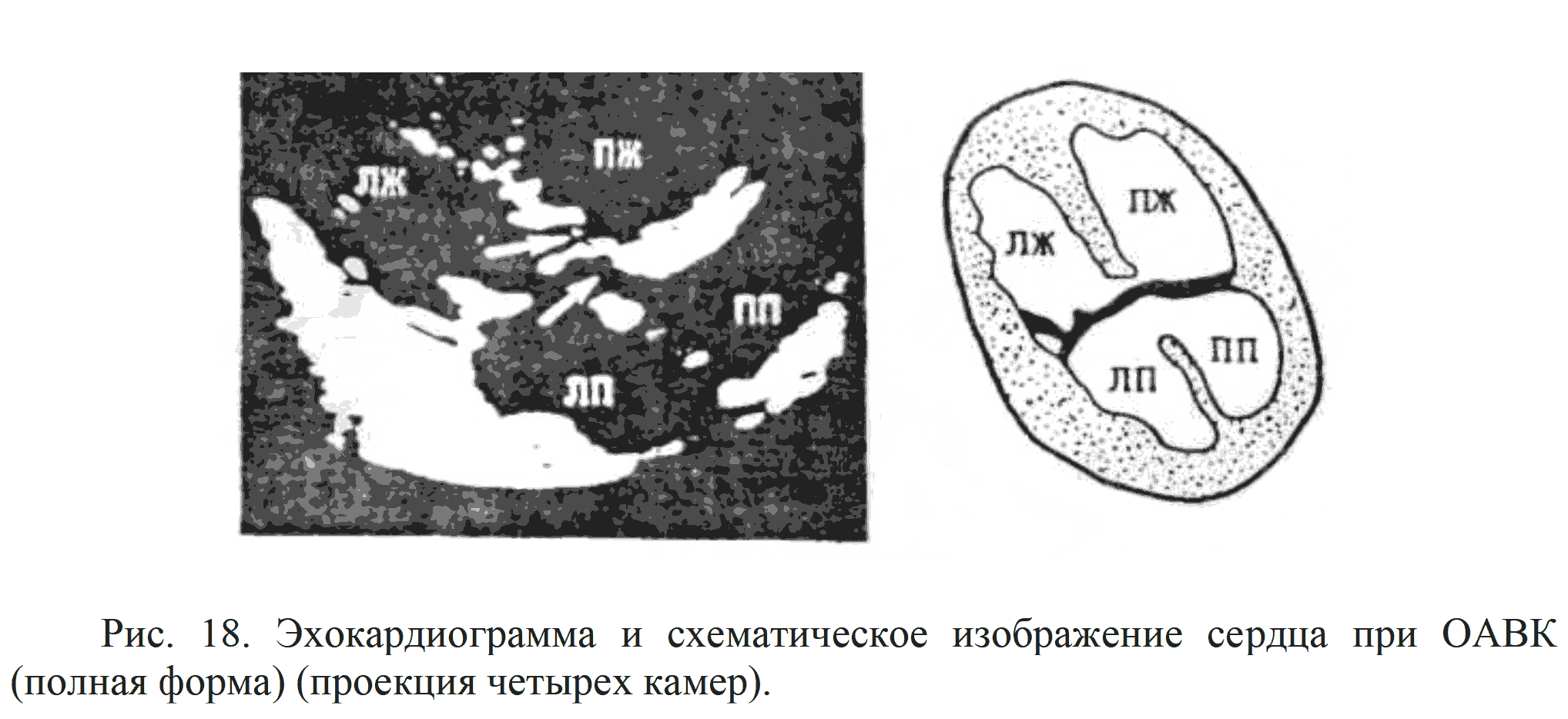 Рис. 18. Эхокардиограмма и схематическое изображение сердца при ОАВК (полная форма) (проекция четырех камер).