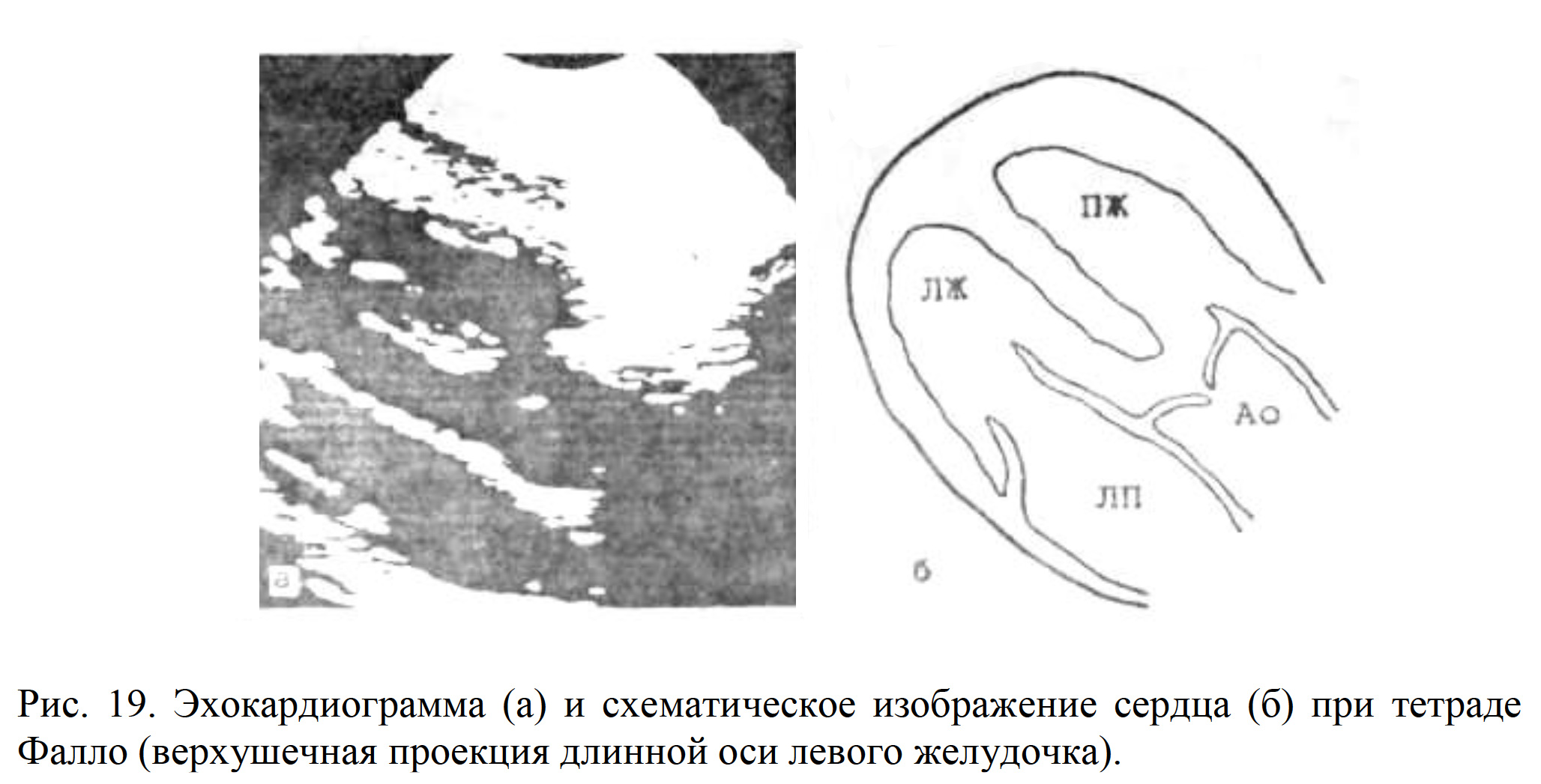 Рис. 19. Эхокардиограмма (а) и схематическое изображение сердца