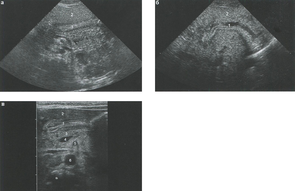 Пилороспазм (разные дети) (1 — привратник; 2 — левая доля печени; 3 — поджелудочная железа; 4 — место слияния селезеночной и верхней брыжеечной вен; 5 — верхняя брыжеечная артерия; 6 — брюшная аорта)