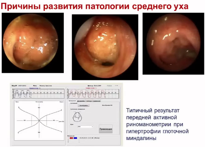 Причины развития патологии среднего уха