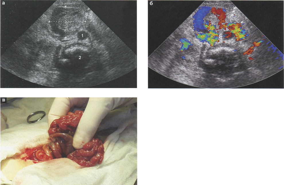 Заворот средней кишки при синдроме Ледда при поперечном сканировании векторным датчиком с частотой 5 МГц 