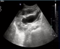 Изменения верхних мочевыводящих путей при физиологический беременности и ОУП