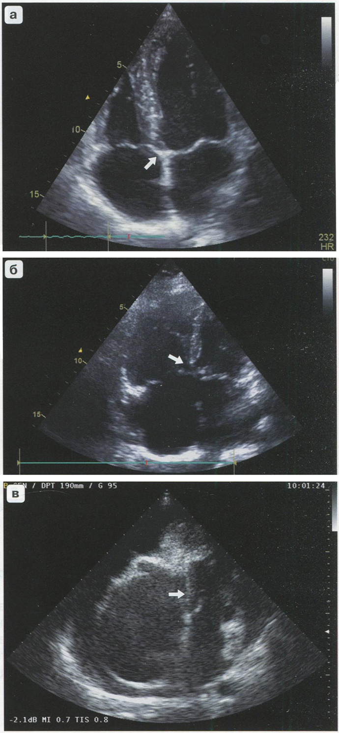 Варианты крепления левого и правого фиброзных колец Варианты крепления левого и правого фиброзных колец