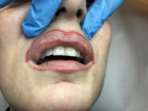 На верхней губе выделяют кожную часть, которая проходит от носогубных складок и носа до края вермилиона