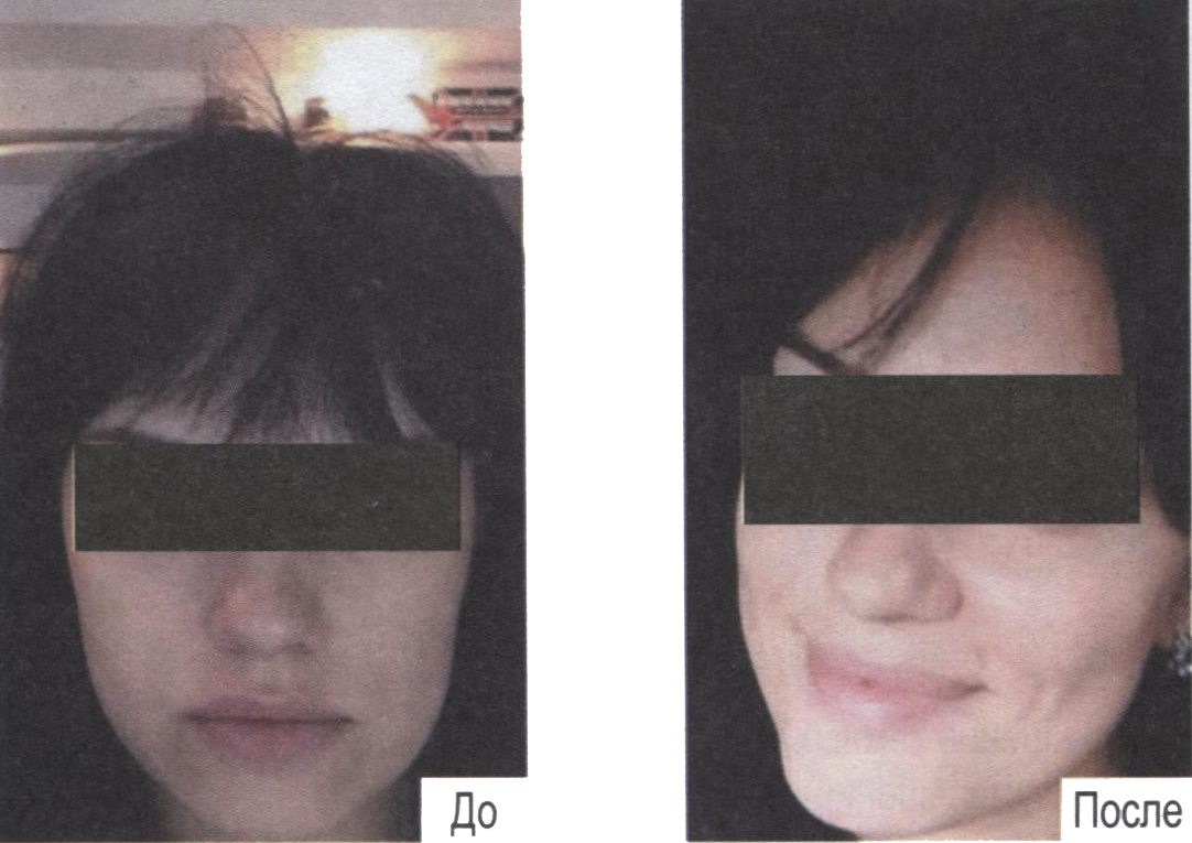 Состояние кожи лица до и после карбокситерапии