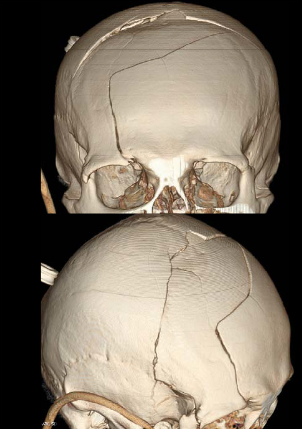 На снимке по МСКТ костей черепа в 3D-реконструкции определяются многооскольчатые переломы лобной кости, теменных костей