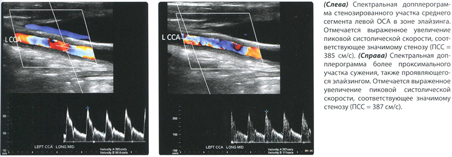Болезнь Такаясу. УЗИ диагностика
