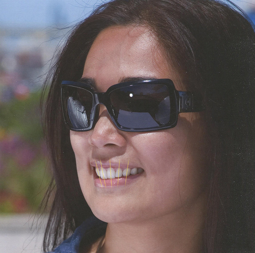 Анатомическое равнение по продольной оси