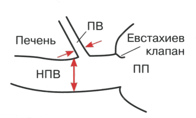 Схема измерения диаметра нижней полой вены и правой печеночной вены. 