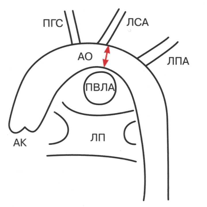 Рис. 2.37. Схема измерения дуги аорты. Супрастернальная позиция