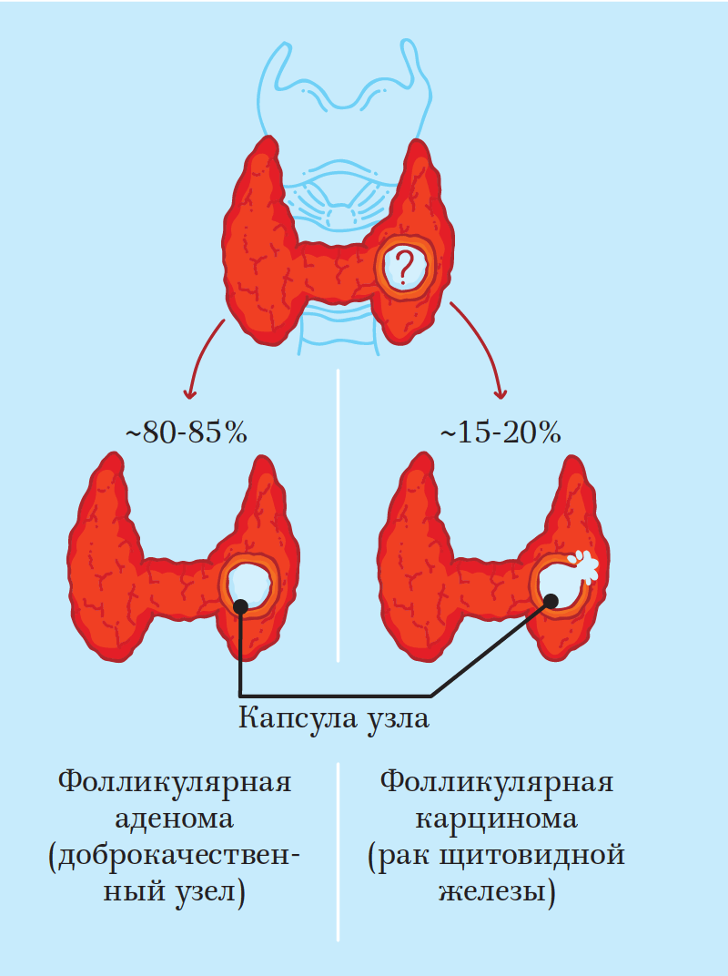Фолликулярная опухоль щитовидной железы