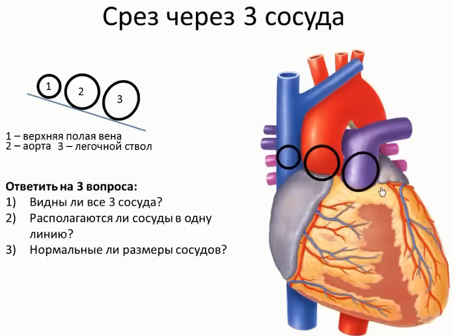 Этапы оценки срезов сердца. Срез через три сосуда