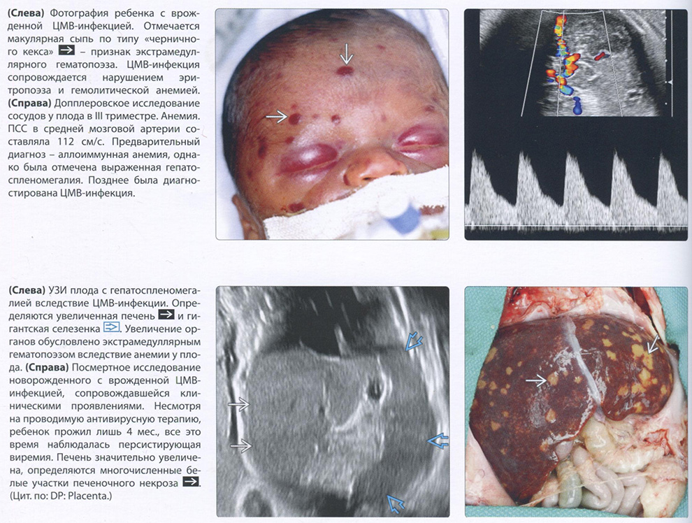 Фотография ребенка с врожденной ЦМ8-инфекцией