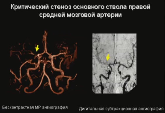 Критический стеноз основного ствола правой средней мозговой артерии