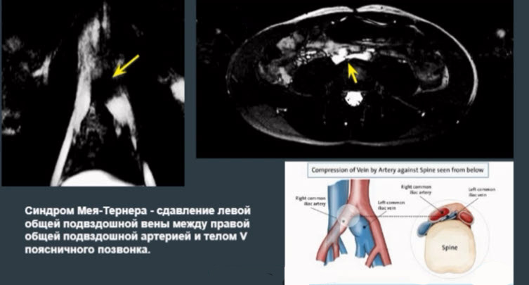 Синдром Мея-Тернера - сдавление левой общей подвздошной вены между правой общей подвздошной артерией