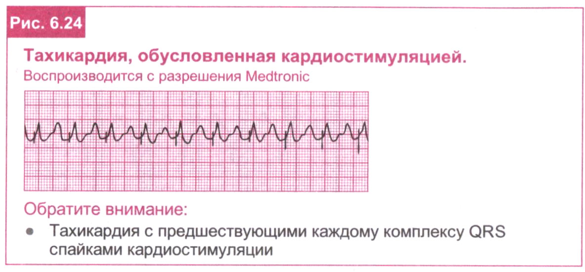 Тахикардия, обусловленная кардиостимуляцией.