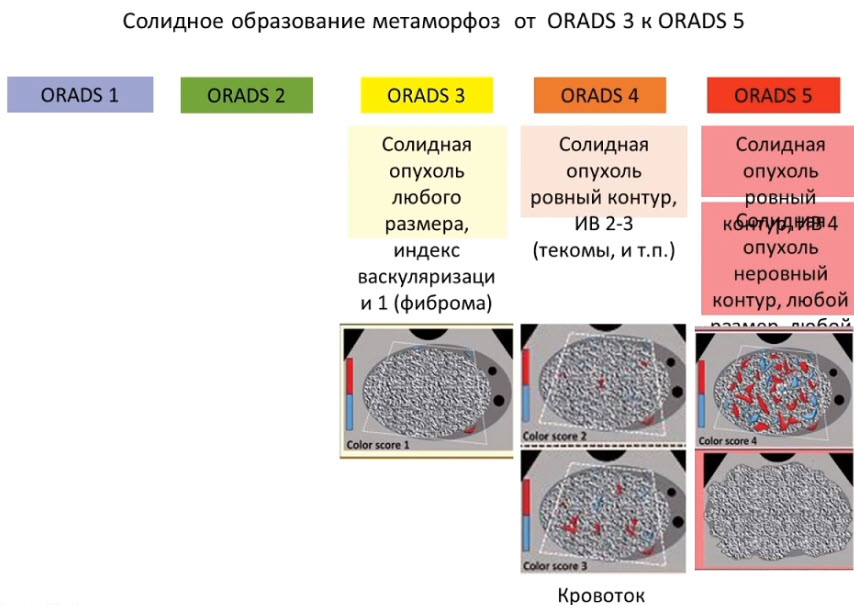 Солидное образование метаморфоз от O-RADS 3 к O-RADS 5