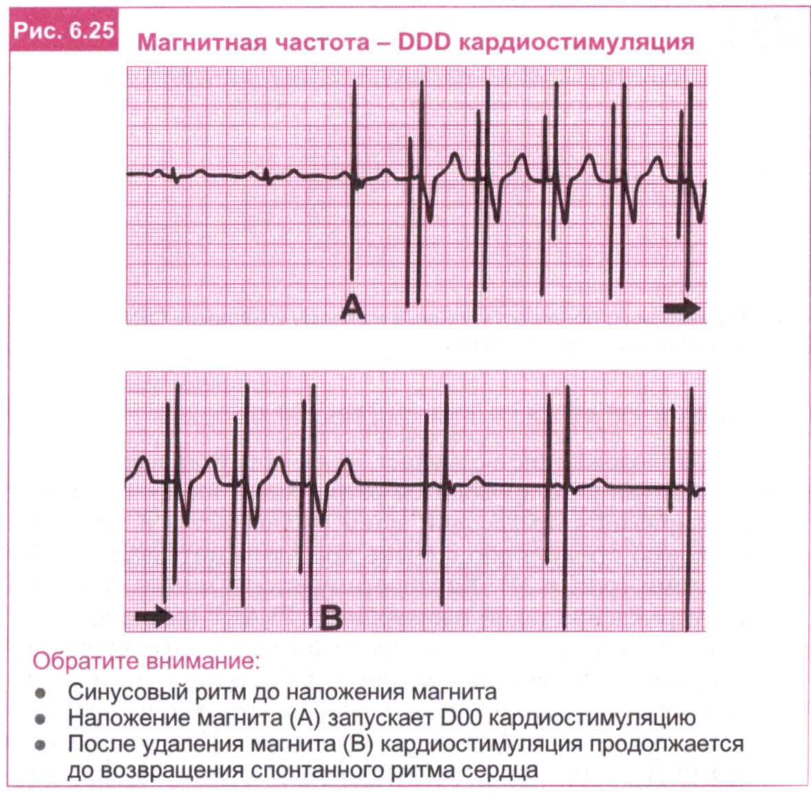 Магнитная частота - DDD кардиостимуляция