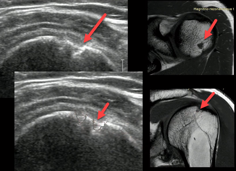 На УЗИ и МРТ изображении кистозная дегенерацию субхондральной поверхности головки плечевой кости