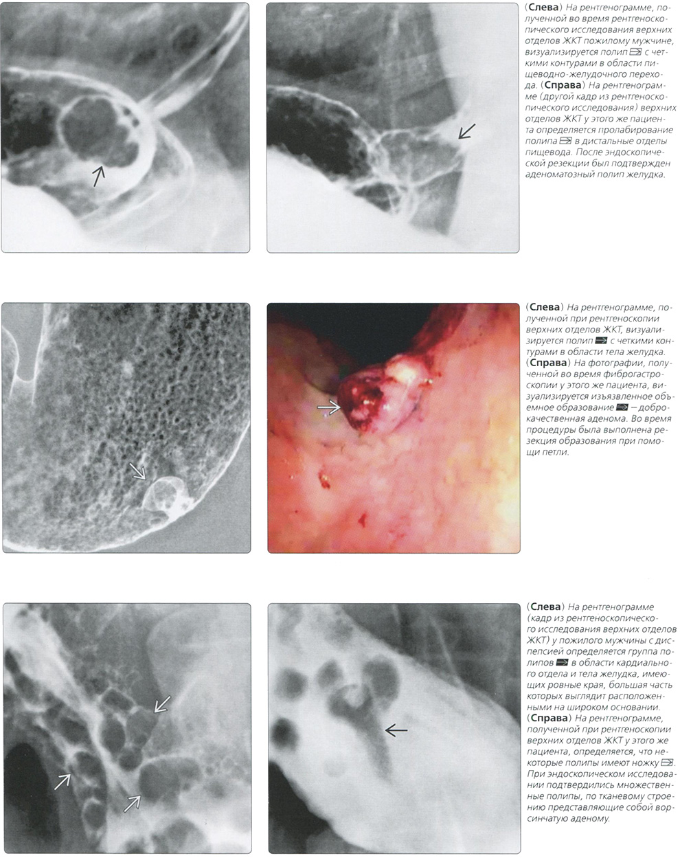 Рентген. Полипы желудка