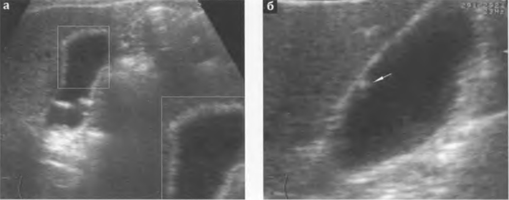 Холестероз стенок желчного пузыря: а - стенка пузыря неравномерно утолщена, эхогенность ее неравномерно повышена, внутренний контур стенки неровный