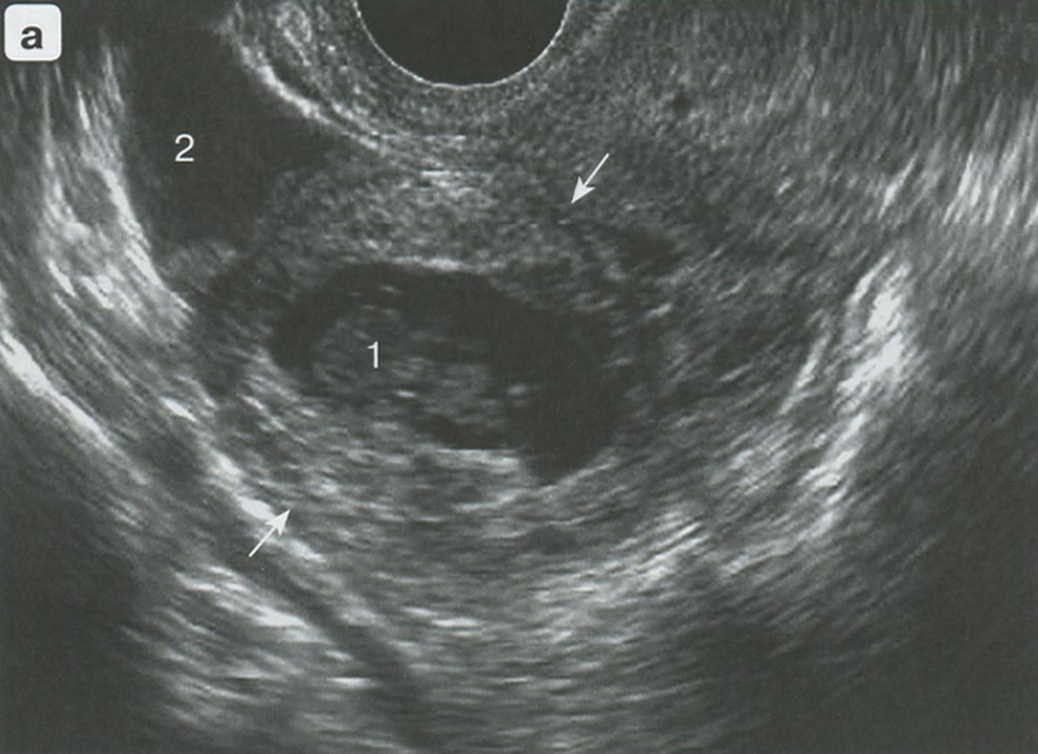 Рис. 7.3. Прерванная ЭБ 7-8 нед. а - в стрелках эктопическая беременность с погибшим эмбрионом