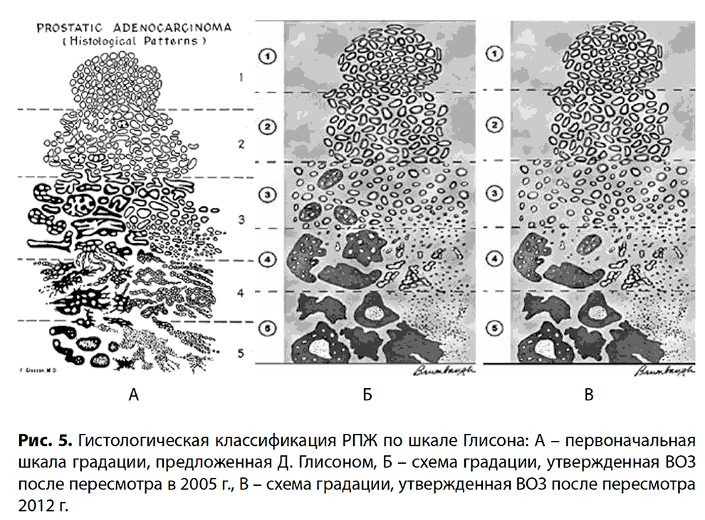 Рис. 5. Гистологическая классификация РПЖ по шкале Глисона