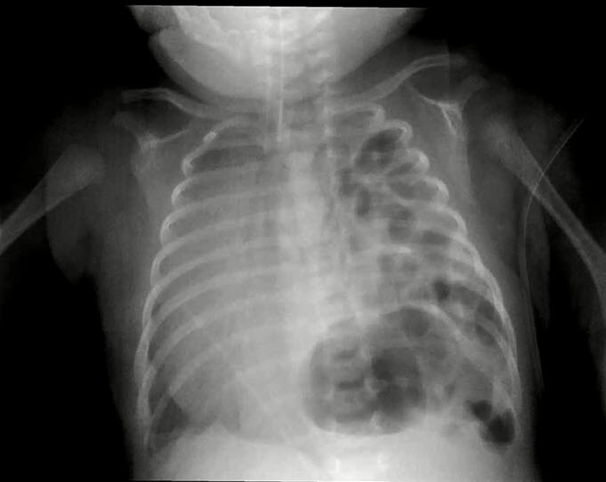 На рентгенограмме органов грудной клетки: левосторонняя диафрагмальная грыжа (новорожденный И.)