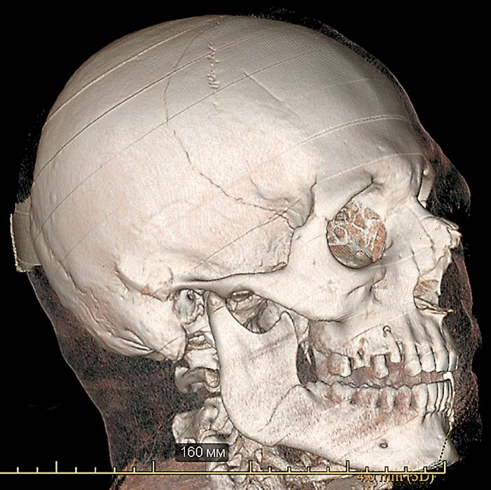 На снимке по МСКТ костей черепа в 3D-реконструкции определяется линейный перелом теменной кости с переходом на височную кость.