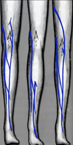 Малая подкожная вена (v. saphena parva) является продолжением наружной краевой вены стопы