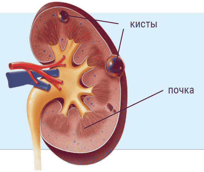 Киста почки – это образование с тонкой капсулой и жидкостным содержимым.