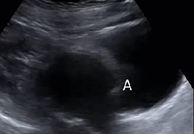 Выраженная деформация тела матки за счет двух миоматозных узлов: в передней стенке