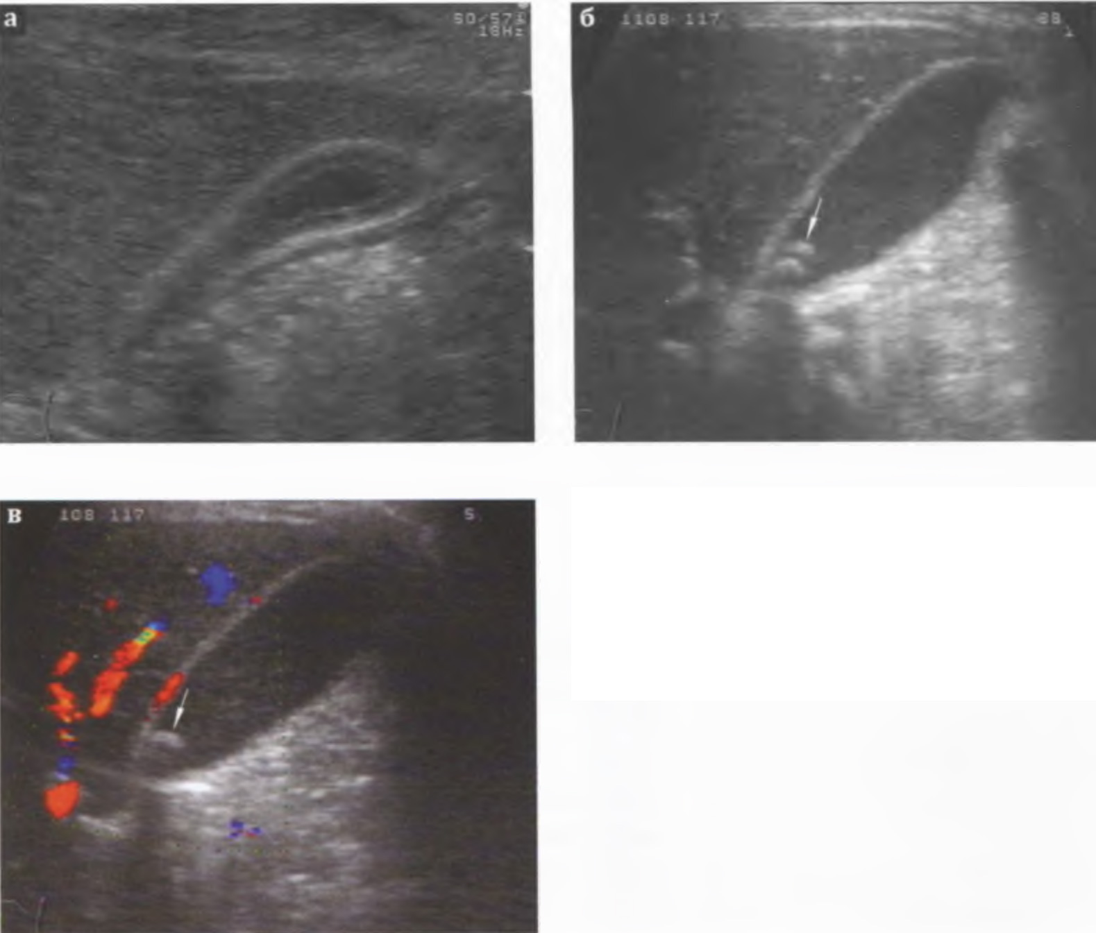  Острый калькулезный холецистит, катаральная форма: умеренное утолщение стенки желчного пузыря.