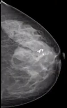 Маммография фиброаденомы