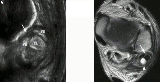 Поперечное изображение частичного расслоения дистального сухожилия короткой малоберцовой мышцы