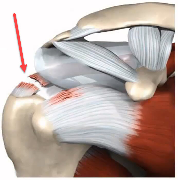 Отрыв полный или частичный надостной мышцы плеча