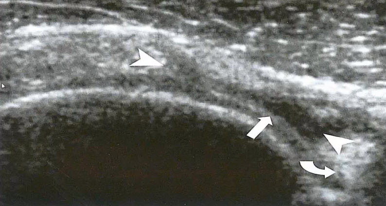 Аксиальный срез по передней области плечевого сустава