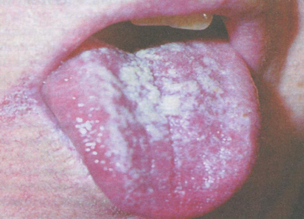 Рис. 36.1. Кандидоз слизистой оболочки полости рта и языка
