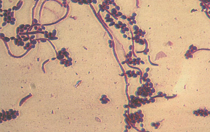 Дрожжевые клетки (бластоспоры) и нити псевдомицелия рода Candida в мазке из материала от больного кандидозом