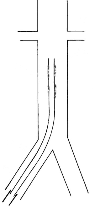 В просвете НПВ визуализируется катетер с эхогенными наложениями, вена компрессируется вокруг катетера, кровоток в НПВ сохранен.